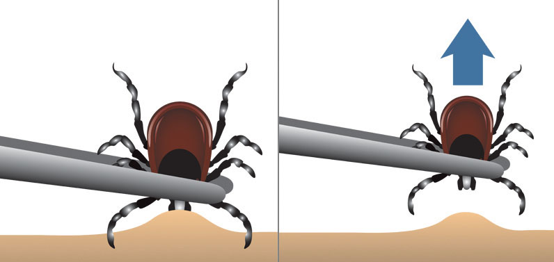 Tick removal from the skin with tweezers